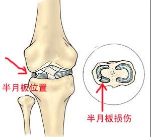 半月板能认定工伤吗多少钱一次工伤赔偿标准及条件