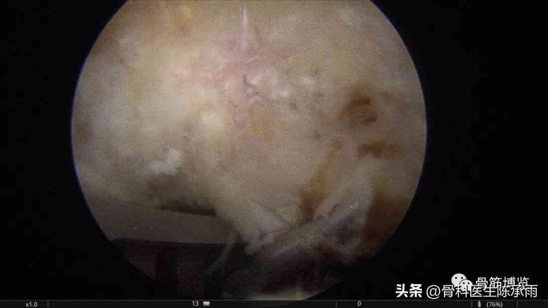 单位肩锁脱位工伤认定标准与赔偿流程解析