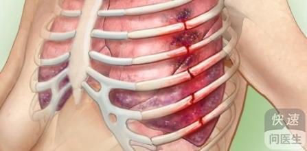 右侧肋骨骨折诊断与治疗要点