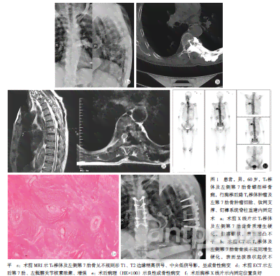 右侧肋骨断裂复时间及恢复全过程解析：从诊断到完全复的全方位指南