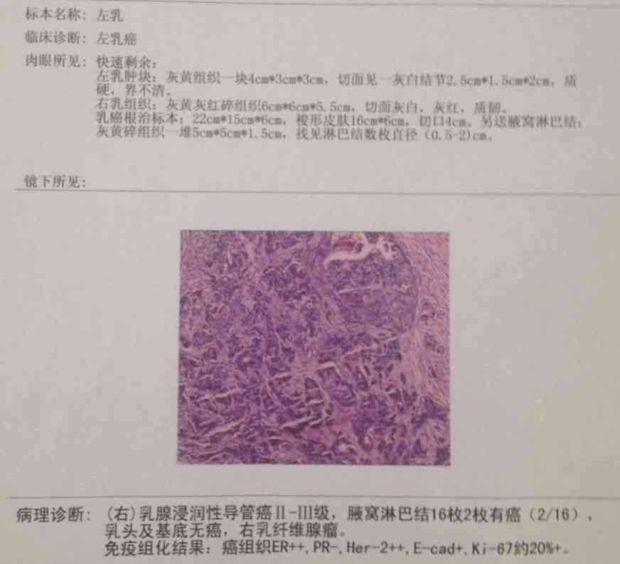 癌病理报告(-)癌症与癌变病理学意义解析