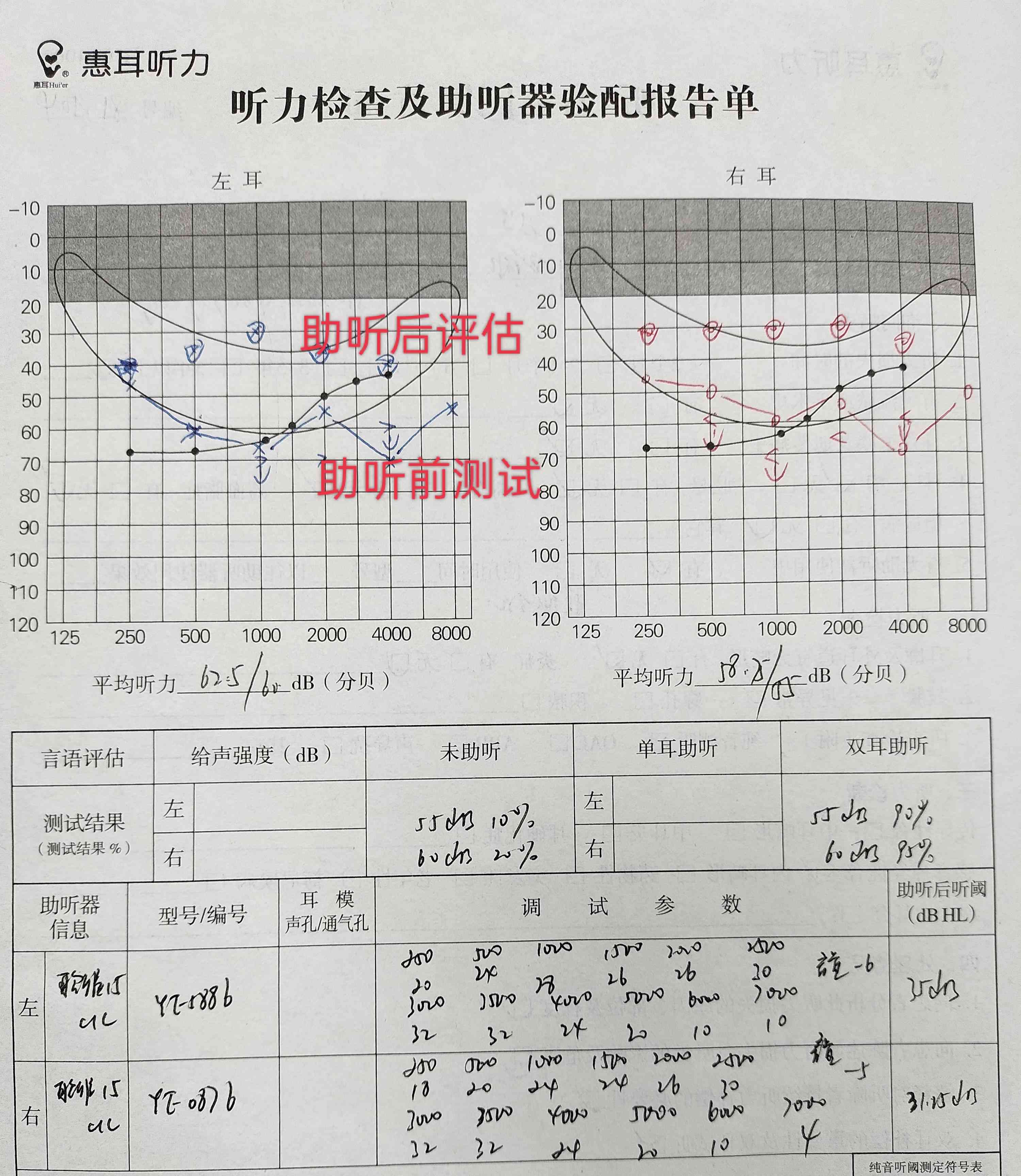 双耳听力35分严重吗：耳朵听力正常值与30分对比分析