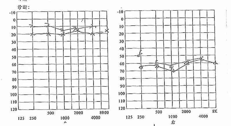 双耳听力35分严重吗：耳朵听力正常值与30分对比分析
