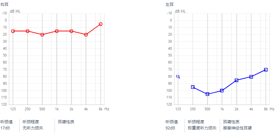 双耳听力35分严重吗：耳朵听力正常值与30分对比分析