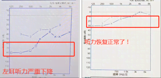 双耳听力35分严重吗：耳朵听力正常值与30分对比分析