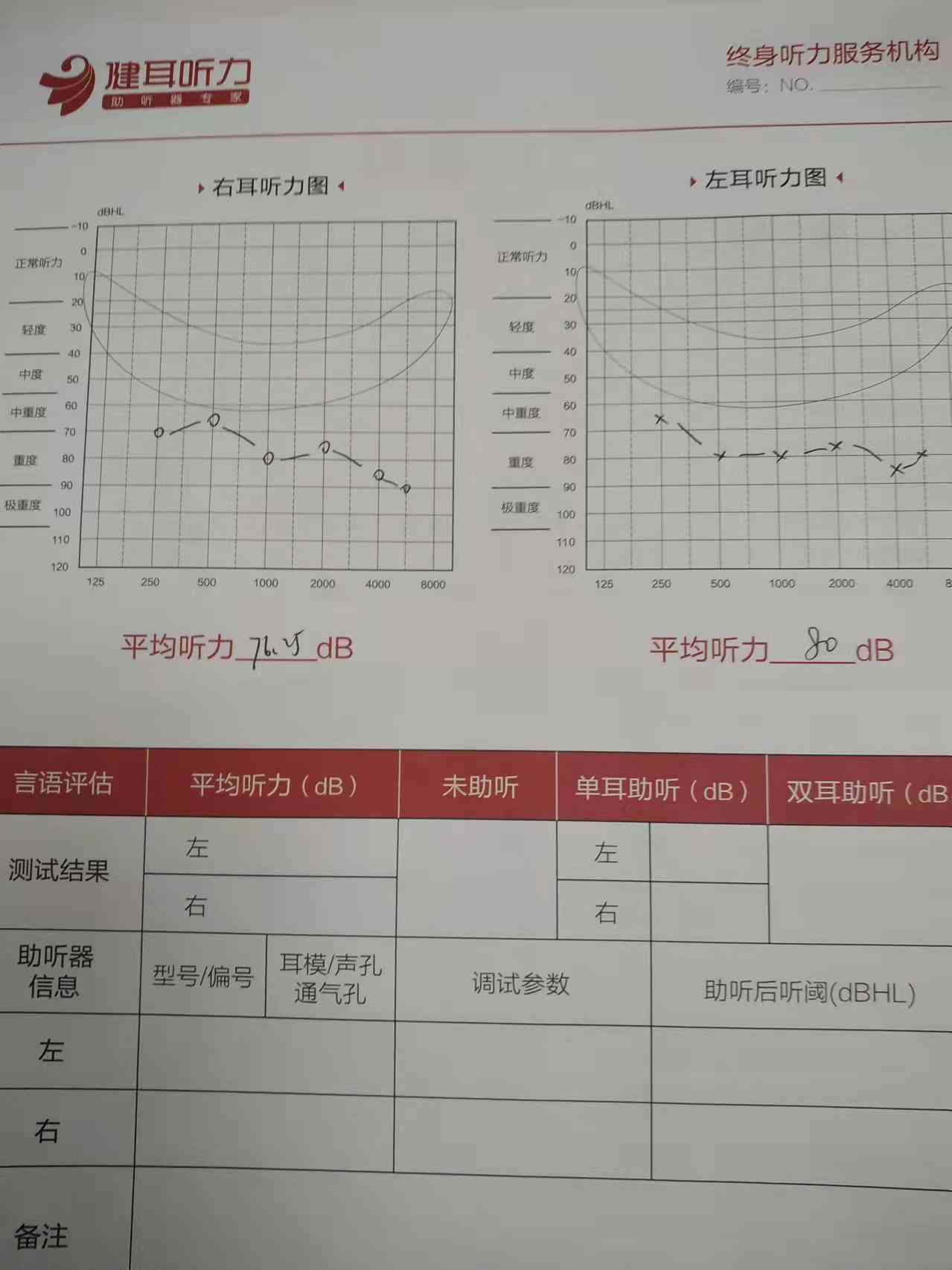 双耳听力35分严重吗：耳朵听力正常值与30分对比分析