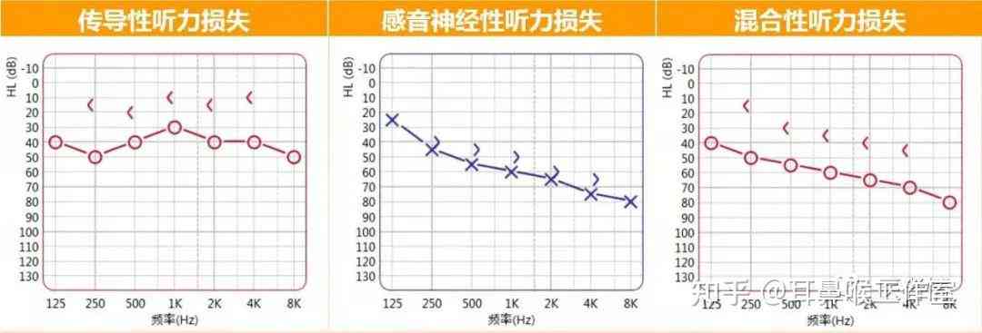 高频听力损失可以评残吗：损失50dB会自愈吗，多久可能致聋？