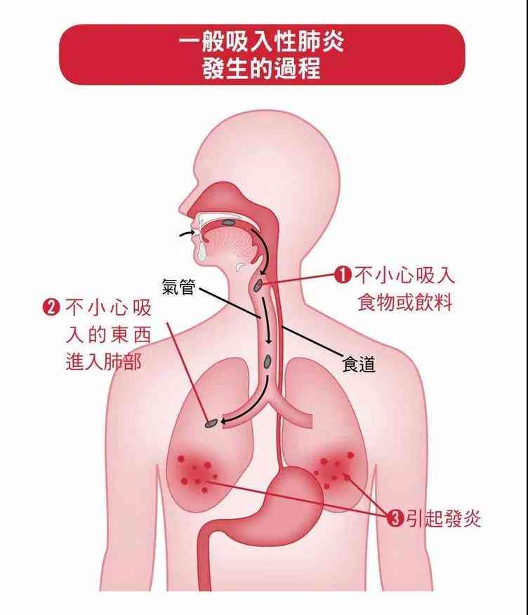 吸入性：是疾病范畴还是意外事故？