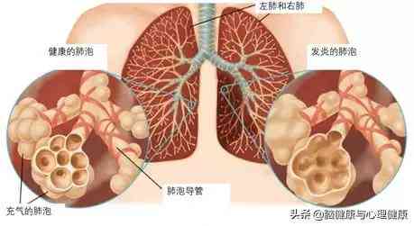 吸入性有生命危险吗，严重程度、传染性及治愈情况分析