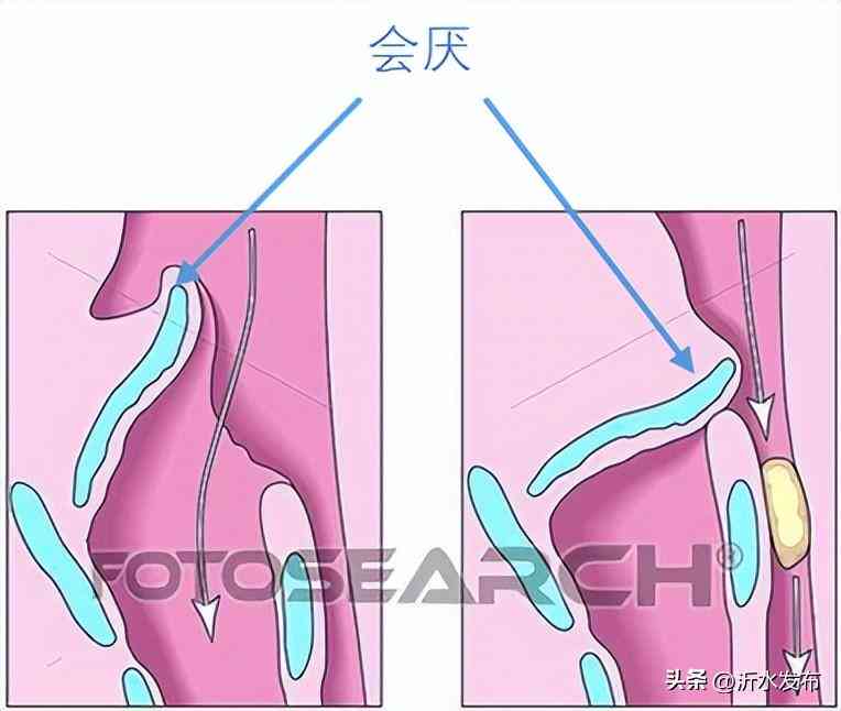 吸入性有生命危险吗，严重程度、传染性及治愈情况分析