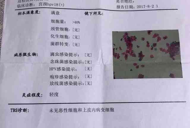 宫颈AI智能筛查解析：HPV与TCT报告单快速解读指南