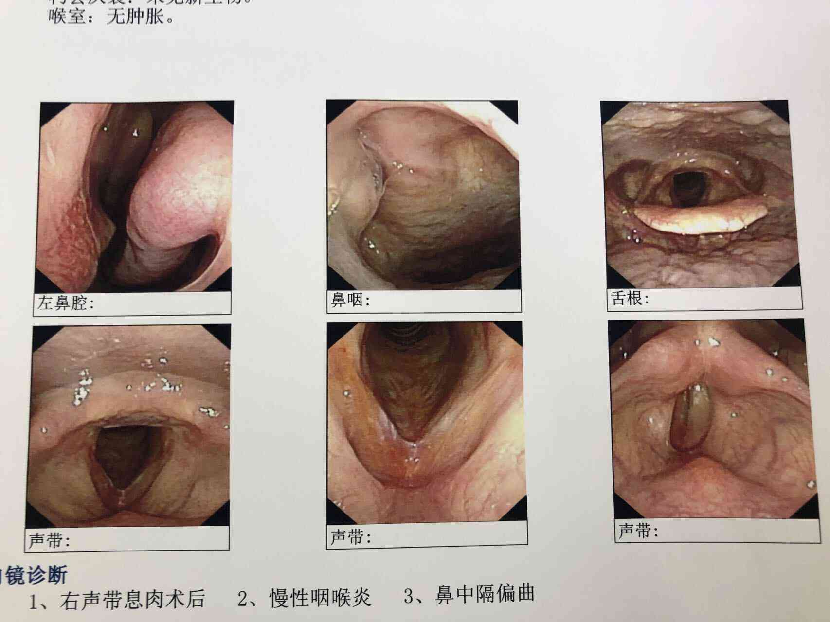 咽喉息肉手术可以报医保吗：医保报销情况及费用解析