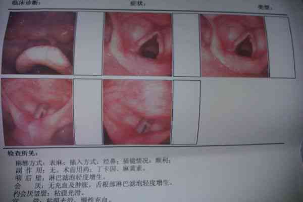 咽喉息肉肉眼下可见性与诊断方法探讨