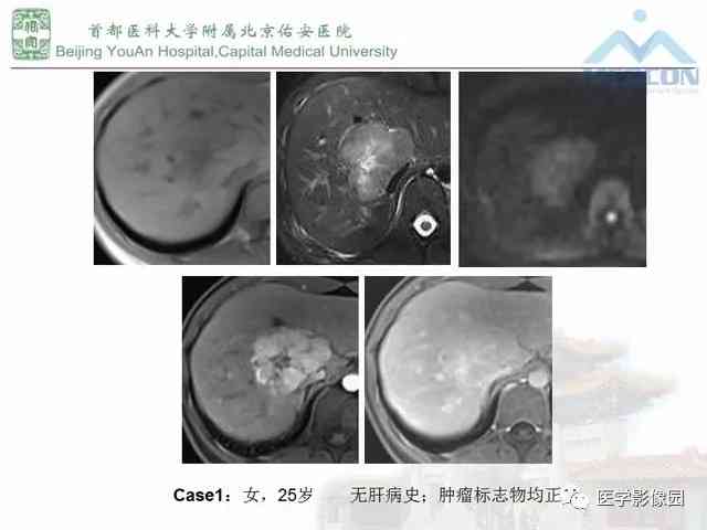 咽喉息肉肉眼下可见性与诊断方法探讨