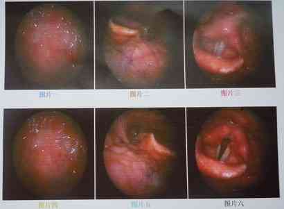 咽喉息肉会癌变的几率高吗及其治疗与预后情况探讨