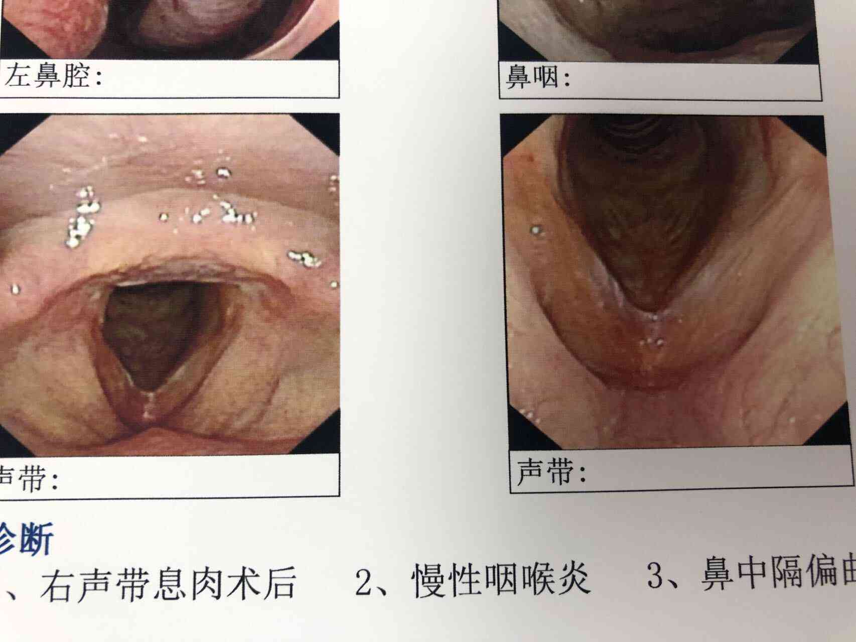 咽喉息肉会癌变的几率高吗及其治疗与预后情况探讨