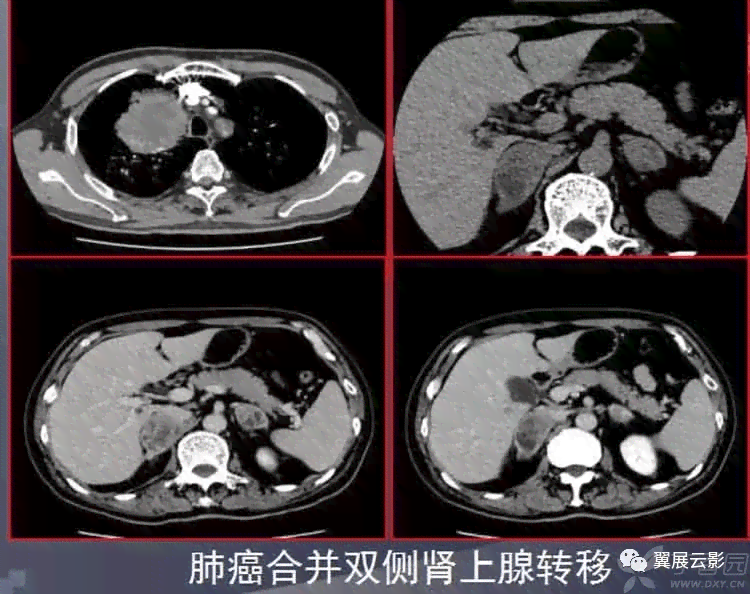 囊肿算职业病吗：探讨囊肿病变、业障病及入职影响