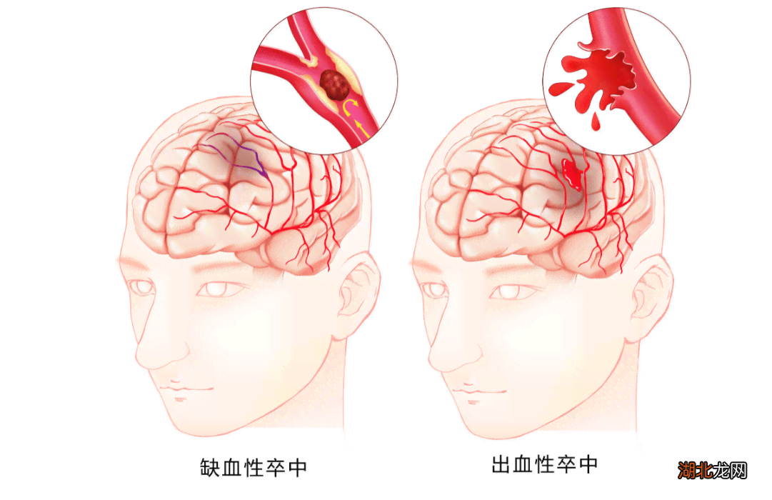 回家途中突发脑出血算不算工伤：包括回家路上脑溢血情况探讨