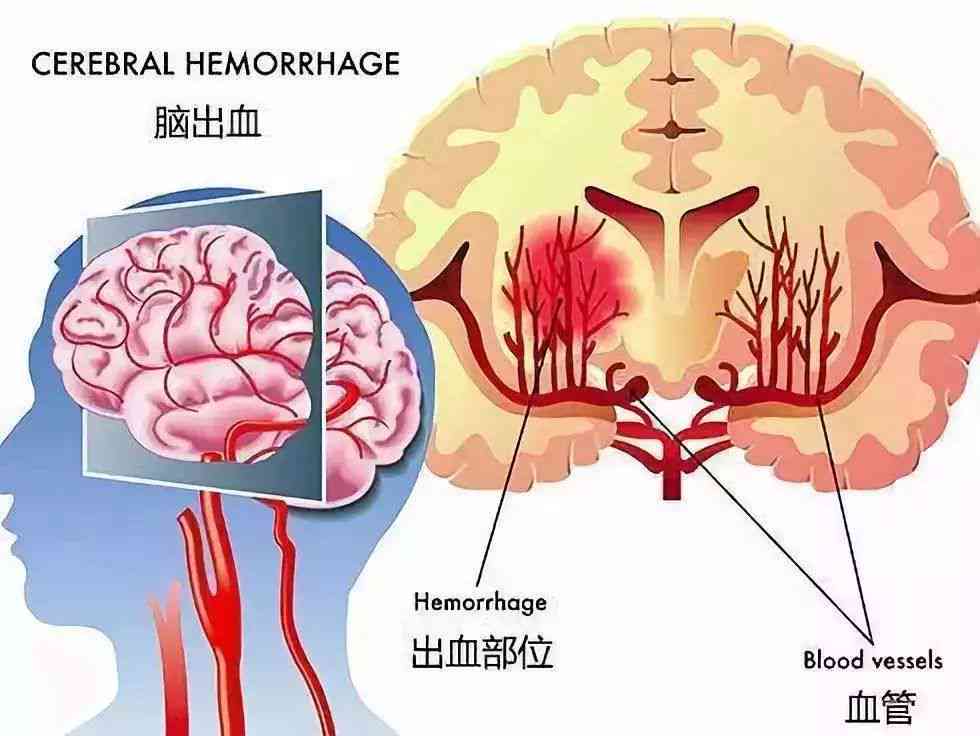 回家途中突发脑出血算不算工伤：包括回家路上脑溢血情况探讨