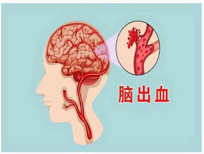 脑出血回家怎么治疗：方法、复技巧及治疗效果分析