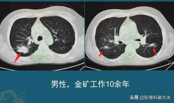 因尘棉患肺癌能认定工伤吗能赔偿吗及赔偿金额详解