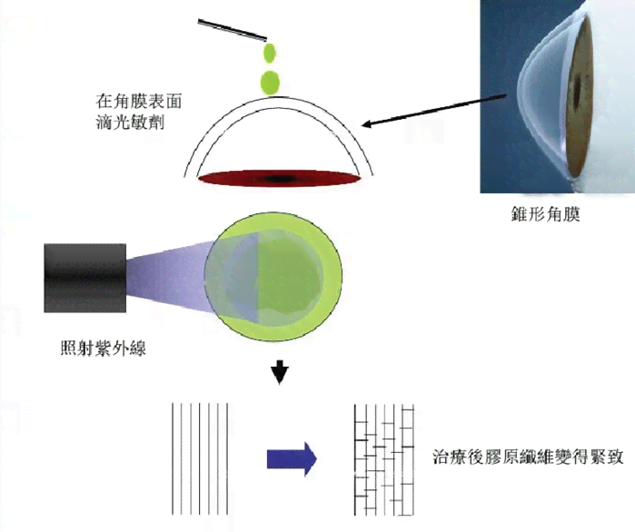 全面解析圆锥角膜：治疗现状、改善可能性与未来展望