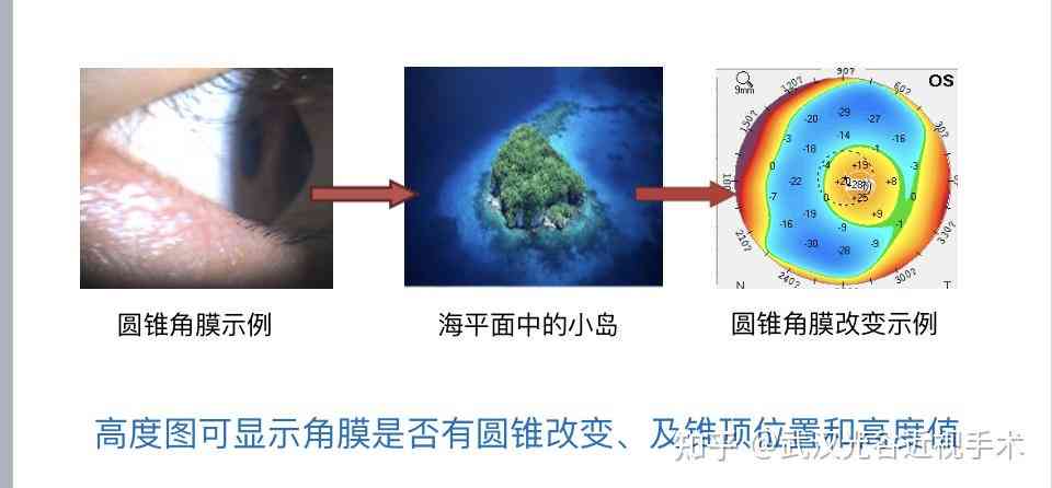 全面解析圆锥角膜：治疗现状、改善可能性与未来展望