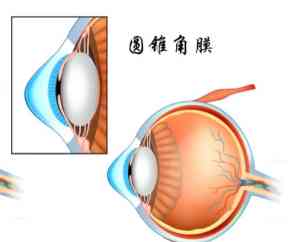 圆锥角膜可以上班工作吗：对职业生涯及夜班工作的影响与注意事项