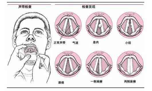 声带白斑认定工伤：其严重性、致命性、发病率及对寿命影响与手术必要性解析