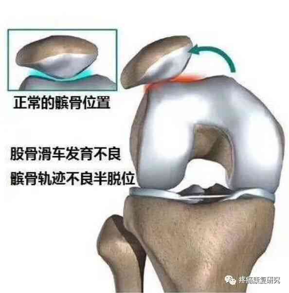 长期忽视：复发性髌骨脱位不手术可能导致的严重后果