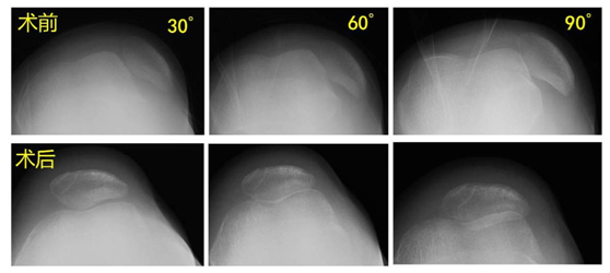 全面解读复发性髌骨脱位：症状、原因、诊断与治疗要点