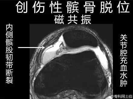 全面解读复发性髌骨脱位：症状、原因、诊断与治疗要点