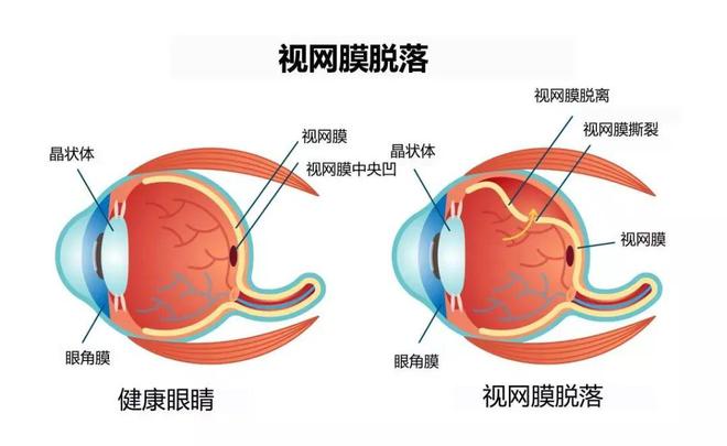 外伤引起的视网膜脱落伤残等级判定及伤残赔偿标准解析