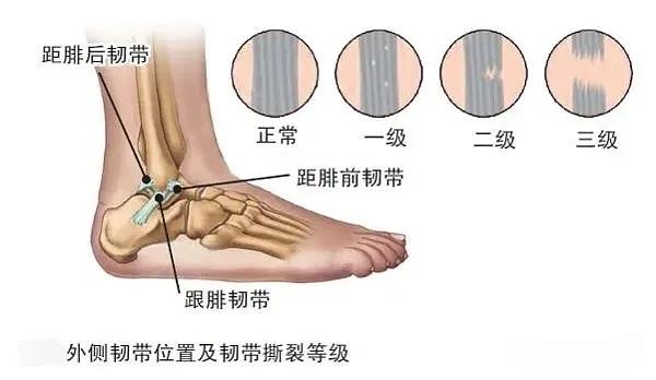 外踝韧带损伤怎么认定工伤等级及症状恢复时长与工伤等级标准解析