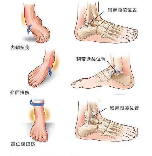 损伤的症状及恢复时间探究 - 外踝韧带损伤的症状与恢复时长解析