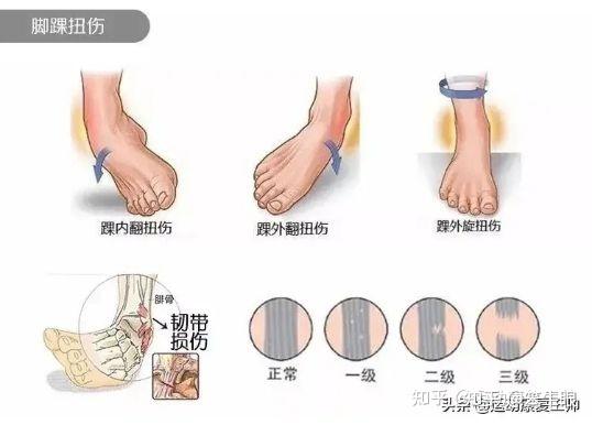 损伤的症状及恢复时间探究 - 外踝韧带损伤的症状与恢复时长解析