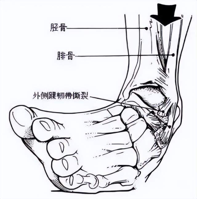 损伤的症状及恢复时间探究 - 外踝韧带损伤的症状与恢复时长解析