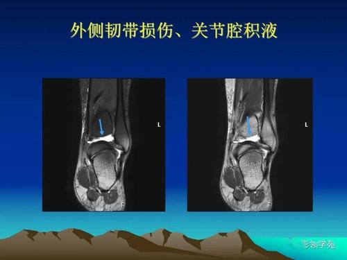 损伤的症状及恢复时间探究 - 外踝韧带损伤的症状与恢复时长解析