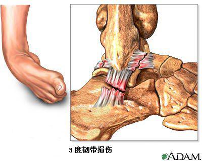 外踝关节韧带损伤：症状、原因、诊断、治疗与复全方位解析