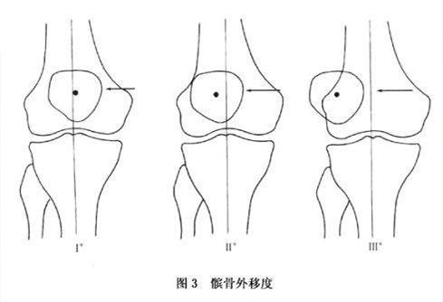 关键大关节脱位：特有体征识别与诊断要点