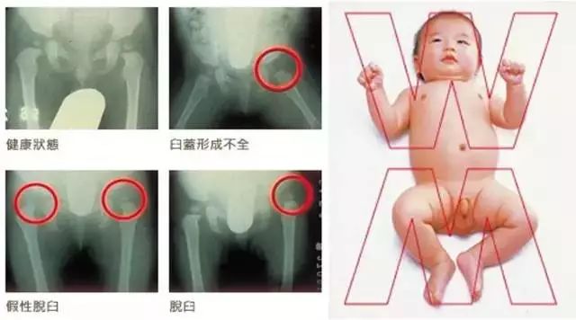 深入了解大关节脱位：原因、症状、治疗与预防全方位解析