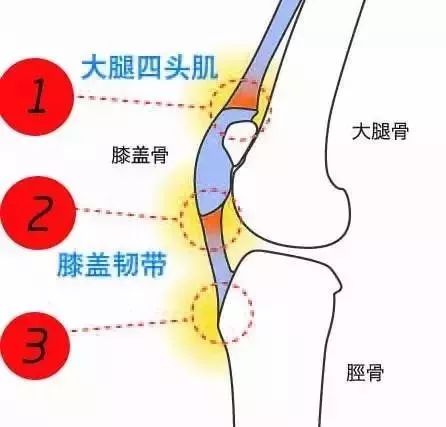 大腿肌肉损伤与修复：常见原因、症状、治疗与复策略