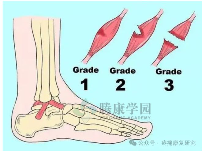 大腿肌肉损伤与修复：常见原因、症状、治疗与复策略