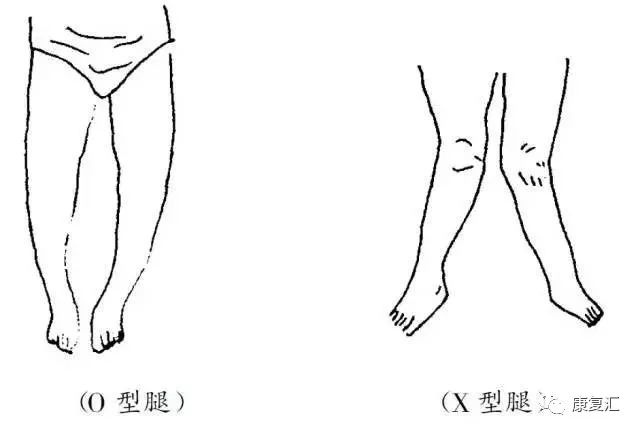 腿部肌肉缺失后能否实现再生与恢复：探讨原因、可能性及治疗方法