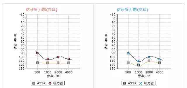 听力检测报告单AI数值为0