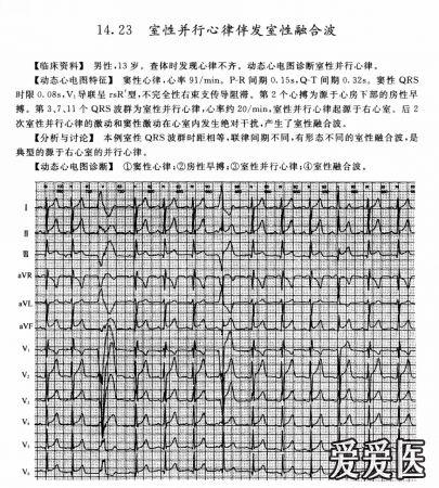 室性早搏可以认定工伤吗