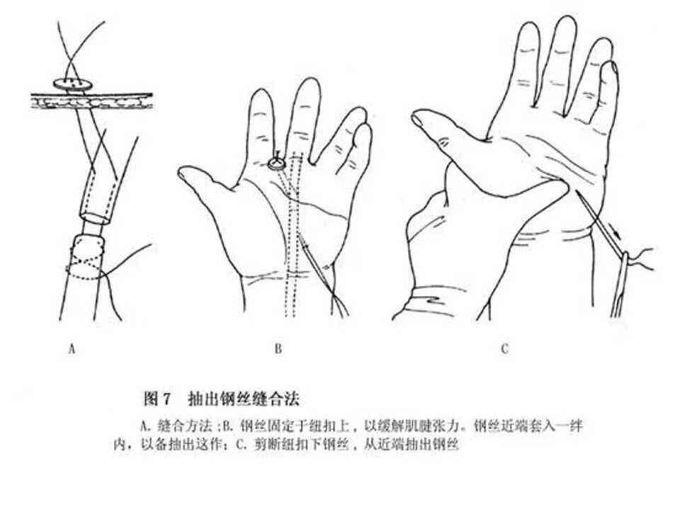 小指肌腱断裂算轻伤吗：损伤程度及恢复时间、伤残级别分析