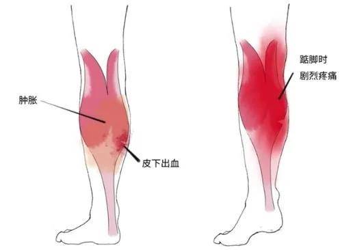 深入了解小腿挫伤：运动损伤解析与复指南