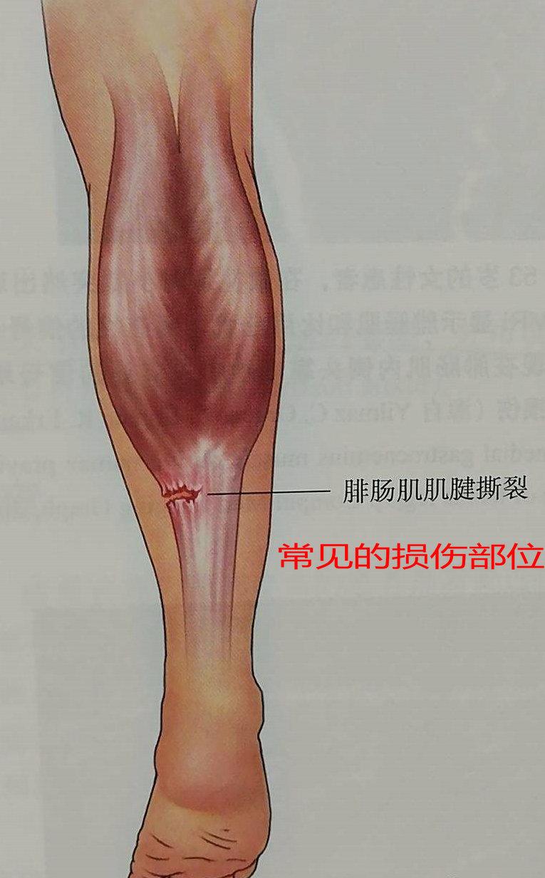 深入了解小腿挫伤：运动损伤解析与复指南