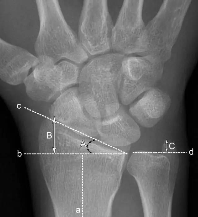 全面解析尺骨撞击综合征：症状、原因、诊断与治疗指南